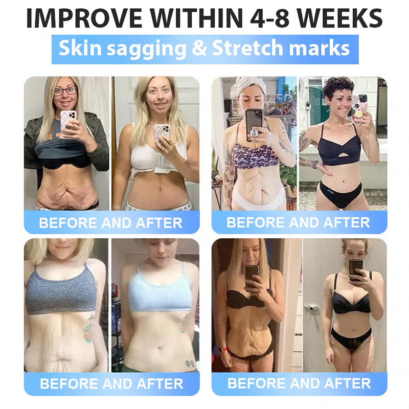 𝐅𝐃𝐀 𝐎𝐟𝐟𝐢𝐜𝐢𝐚𝐥 𝐒𝐭𝐨𝐫𝐞 | 𝐌𝐲𝐨 𝐂𝐥𝐢𝐧𝐢𝐜 𝐆𝐋𝐏-𝟏 𝐒𝐥𝐢𝐦 & 𝐅𝐢𝐫𝐦 𝐍𝐚𝐧𝐨 𝐌𝐢𝐜𝐫𝐨𝐧𝐞𝐞𝐝𝐥𝐞 𝐏𝐚𝐭𝐜𝐡 𝐰𝐢𝐭𝐡 𝐂𝐨𝐥𝐥𝐚𝐠𝐞𝐧, 𝐓𝐮𝐫𝐦𝐞𝐫𝐢𝐜 & 𝐌𝐚𝐭𝐫𝐢𝐱𝐲𝐥 𝟑𝟎𝟎𝟎丨𝐎𝐛𝐞𝐬𝐢𝐭𝐲, 𝐂𝐚𝐫𝐝𝐢𝐨𝐯𝐚𝐬𝐜𝐮𝐥𝐚𝐫 𝐃𝐢𝐬𝐞𝐚𝐬𝐞, 𝐃𝐢𝐚𝐛𝐞𝐭𝐞𝐬, 𝐒𝐥𝐞𝐞𝐩 𝐀𝐩𝐧𝐞𝐚, 𝐉𝐨𝐢𝐧𝐭 𝐏𝐫𝐨𝐛𝐥𝐞𝐦𝐬 𝐚𝐧𝐝 𝐌𝐨𝐫𝐞 (𝐂𝐨𝐩𝐲)