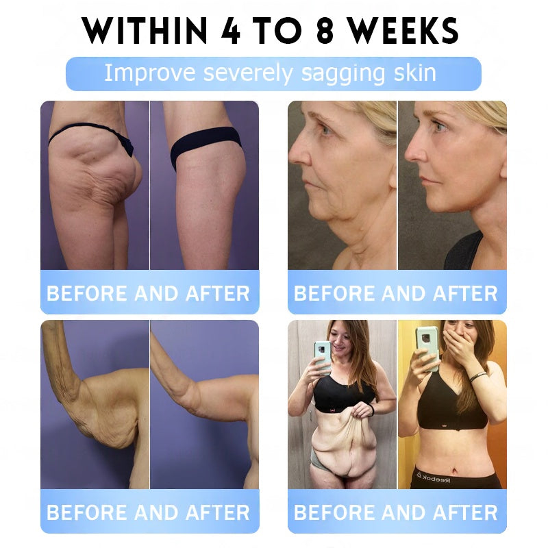 𝐅𝐃𝐀 𝐎𝐟𝐟𝐢𝐜𝐢𝐚𝐥 𝐒𝐭𝐨𝐫𝐞 | 𝐌𝐲𝐨 𝐂𝐥𝐢𝐧𝐢𝐜 𝐆𝐋𝐏-𝟏 𝐒𝐥𝐢𝐦 & 𝐅𝐢𝐫𝐦 𝐍𝐚𝐧𝐨 𝐌𝐢𝐜𝐫𝐨𝐧𝐞𝐞𝐝𝐥𝐞 𝐏𝐚𝐭𝐜𝐡 𝐰𝐢𝐭𝐡 𝐂𝐨𝐥𝐥𝐚𝐠𝐞𝐧, 𝐓𝐮𝐫𝐦𝐞𝐫𝐢𝐜 & 𝐌𝐚𝐭𝐫𝐢𝐱𝐲𝐥 𝟑𝟎𝟎𝟎丨𝐎𝐛𝐞𝐬𝐢𝐭𝐲, 𝐂𝐚𝐫𝐝𝐢𝐨𝐯𝐚𝐬𝐜𝐮𝐥𝐚𝐫 𝐃𝐢𝐬𝐞𝐚𝐬𝐞, 𝐃𝐢𝐚𝐛𝐞𝐭𝐞𝐬, 𝐒𝐥𝐞𝐞𝐩 𝐀𝐩𝐧𝐞𝐚, 𝐉𝐨𝐢𝐧𝐭 𝐏𝐫𝐨𝐛𝐥𝐞𝐦𝐬 𝐚𝐧𝐝 𝐌𝐨𝐫𝐞 (𝐂𝐨𝐩𝐲)