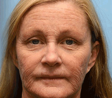 Official Store | Rejuvenate Your Skin Instantly 💫 STDEI® BOTOX & VITA A RETINOL SHOT Anti-Wrinkle Lifting & Firming Cream